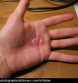 Photo of a hand with a blister
