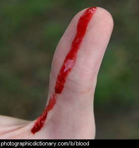 Photo of a bleeding thumb.