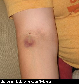Photo of a bruised arm