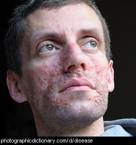 Photo of a sick man with a spotty face