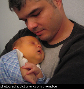 Photo of a baby with jaundice