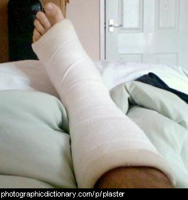 Photo of a broken leg in plaster