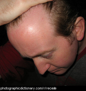 Photo of a man with a receding hairline