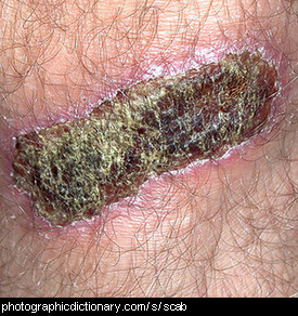 Photo of a scab