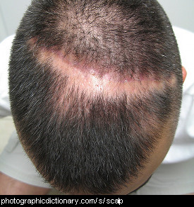 Photo of a man's scalp