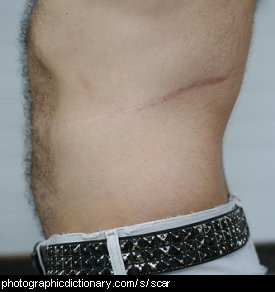 Photo of a scar
