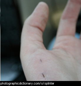 Photo of a hand with a splinter in it