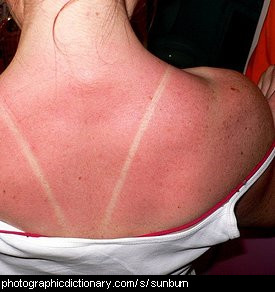 Photo of a sunburnt back