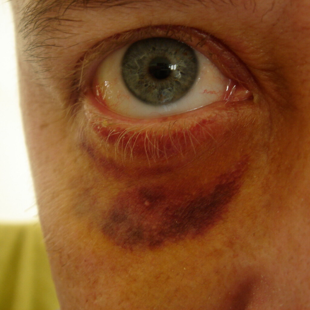 Photo of a black eye