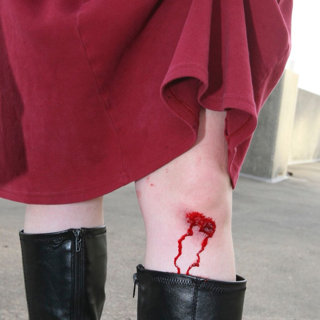 Photo of a bleeding knee