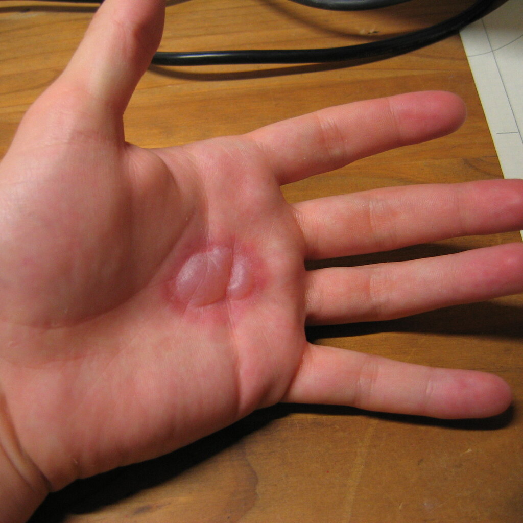 Photo of a hand with a blister