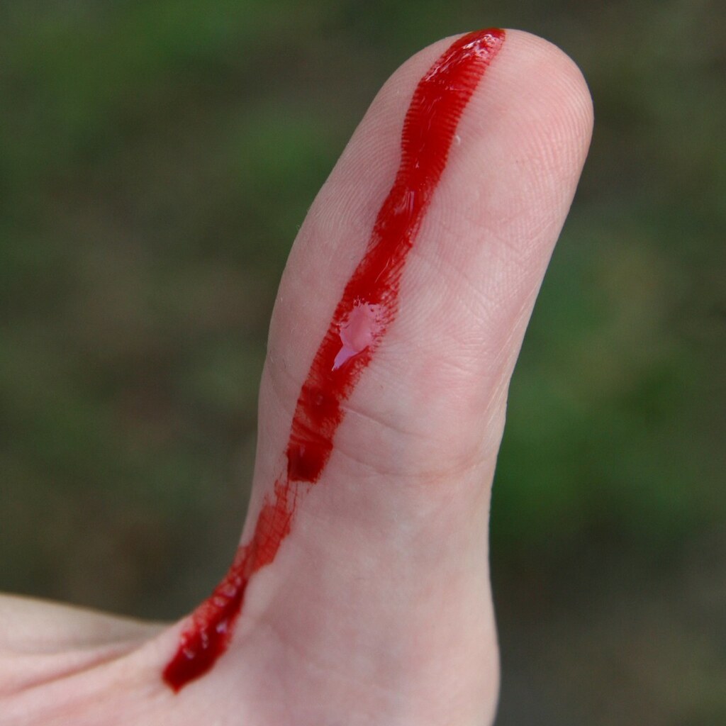 Photo of a bleeding thumb.