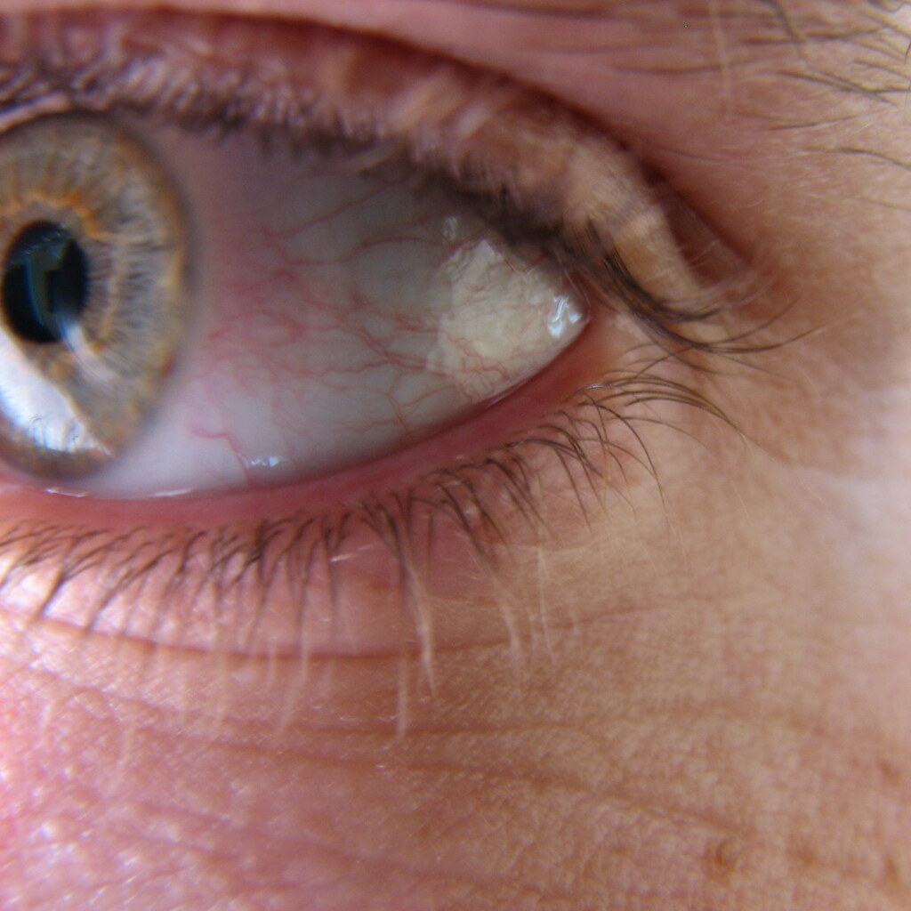 Photo of bloodshot eyes.