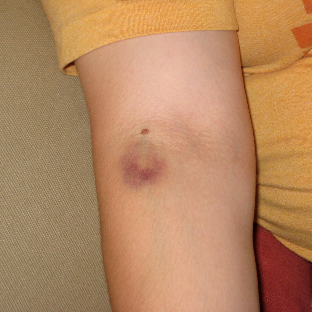 Photo of a bruised arm