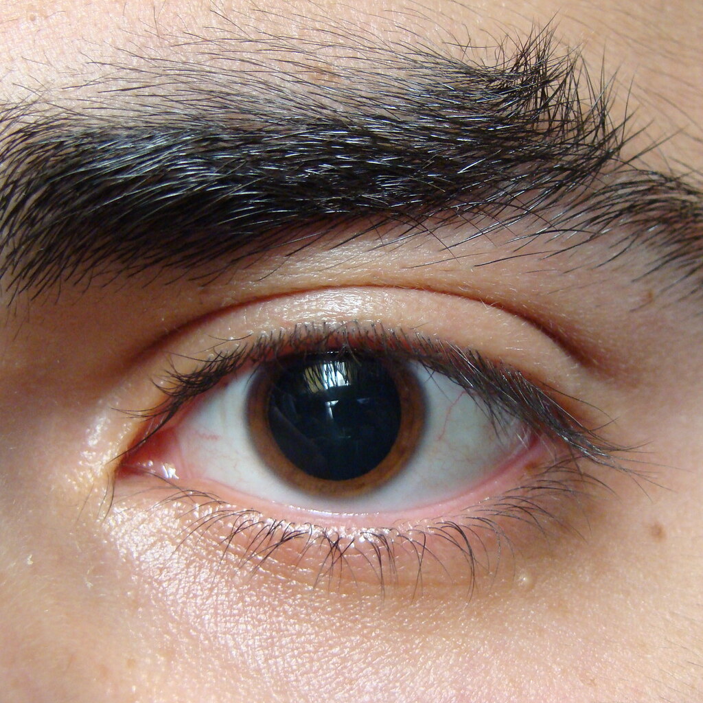 Photo of a dilated eye