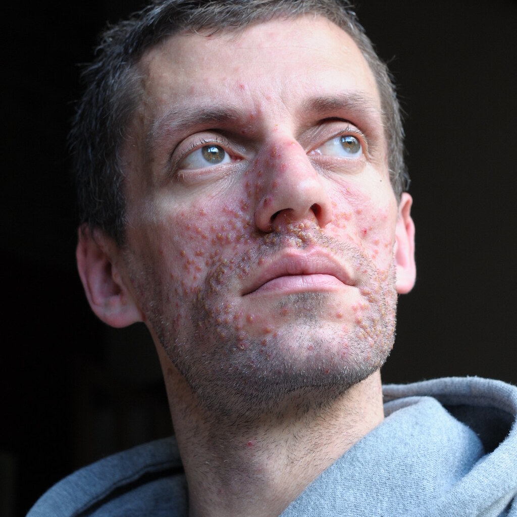 Photo of a sick man with a spotty face