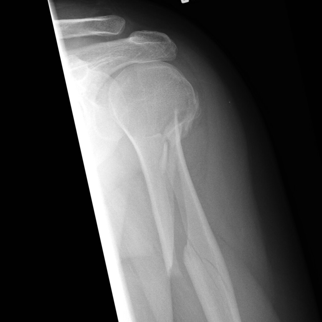 Photo of an x-ray of a broken arm