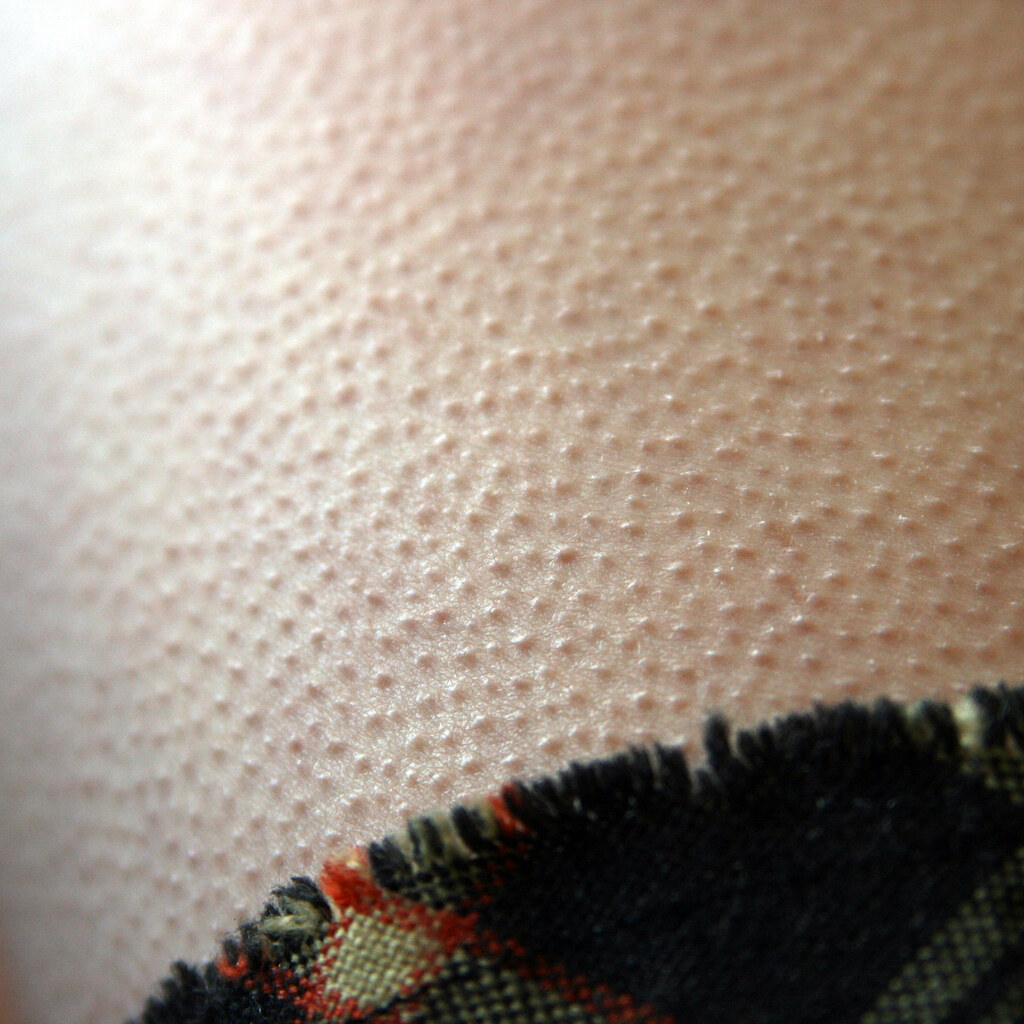 Photo of goosebumps