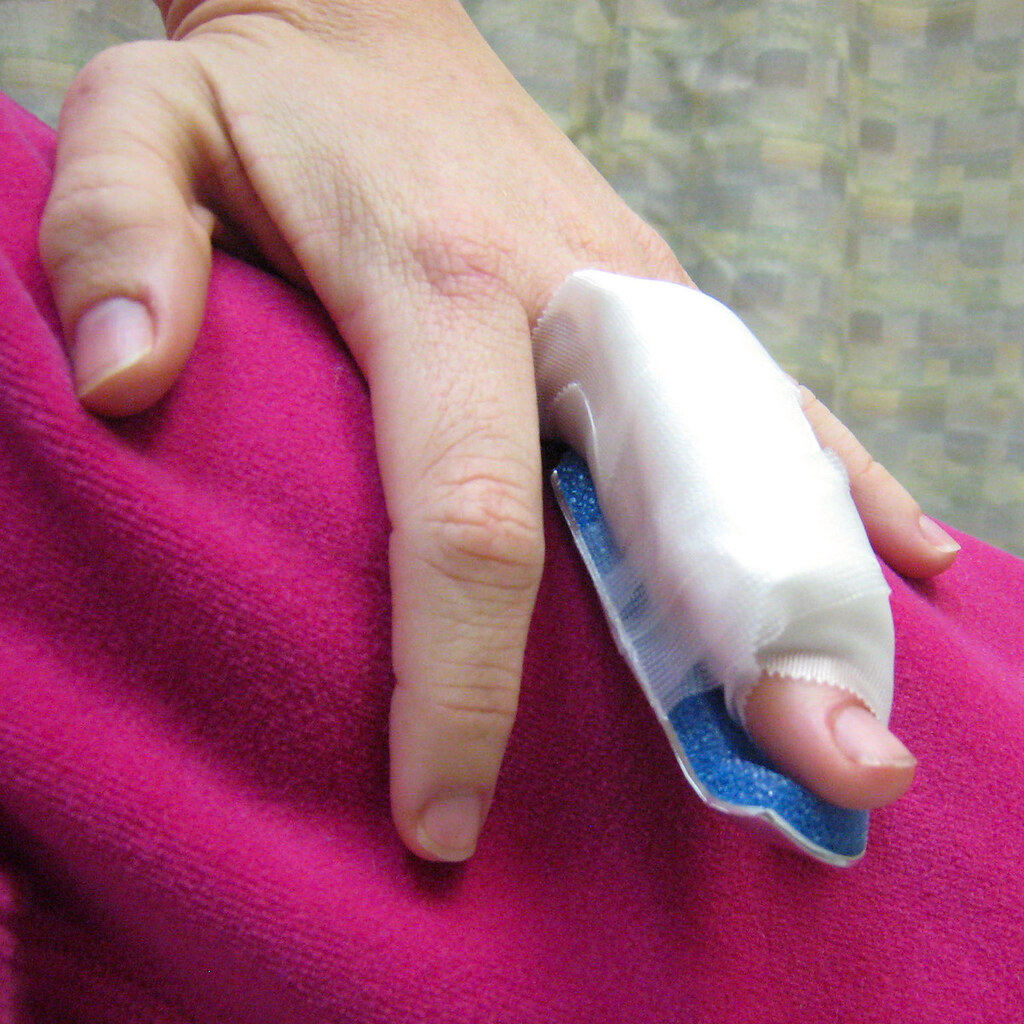 Photo of an injured finger