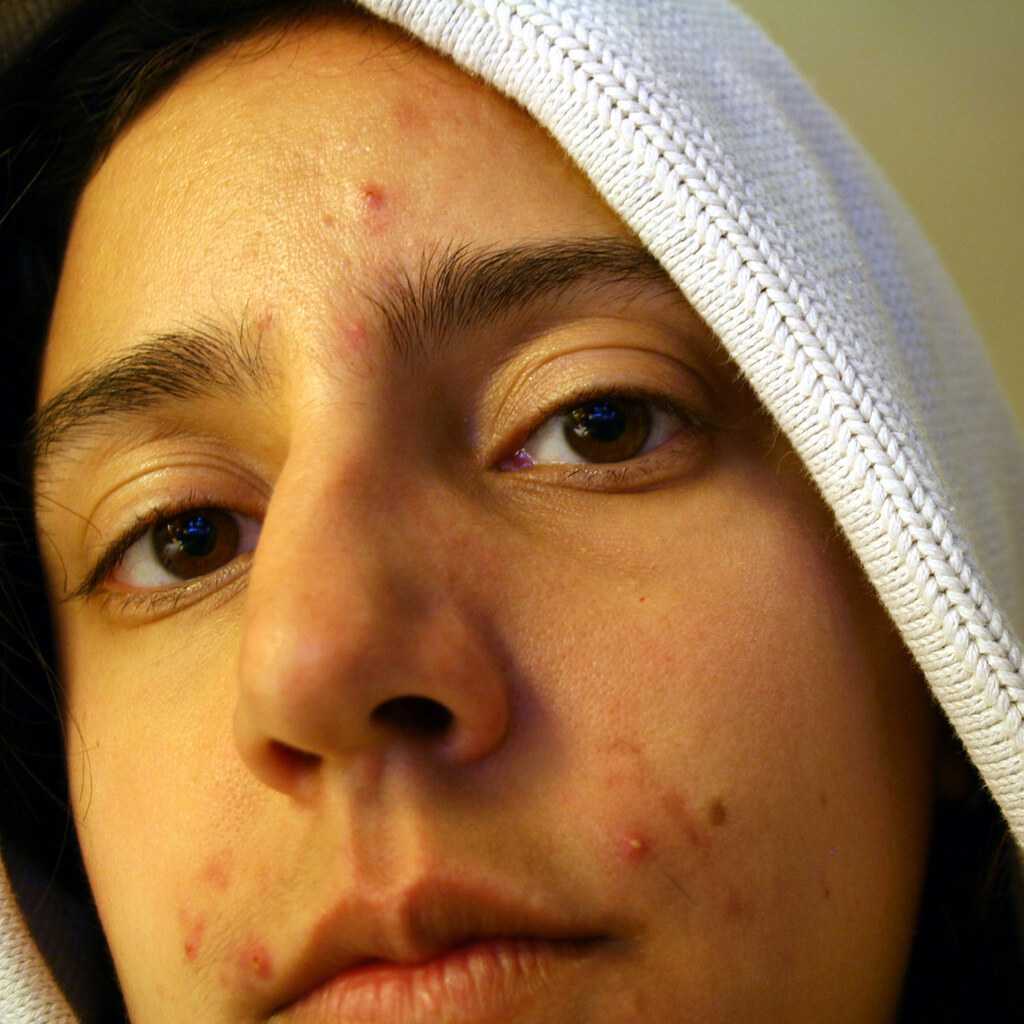 Photo of a teenager with pimples