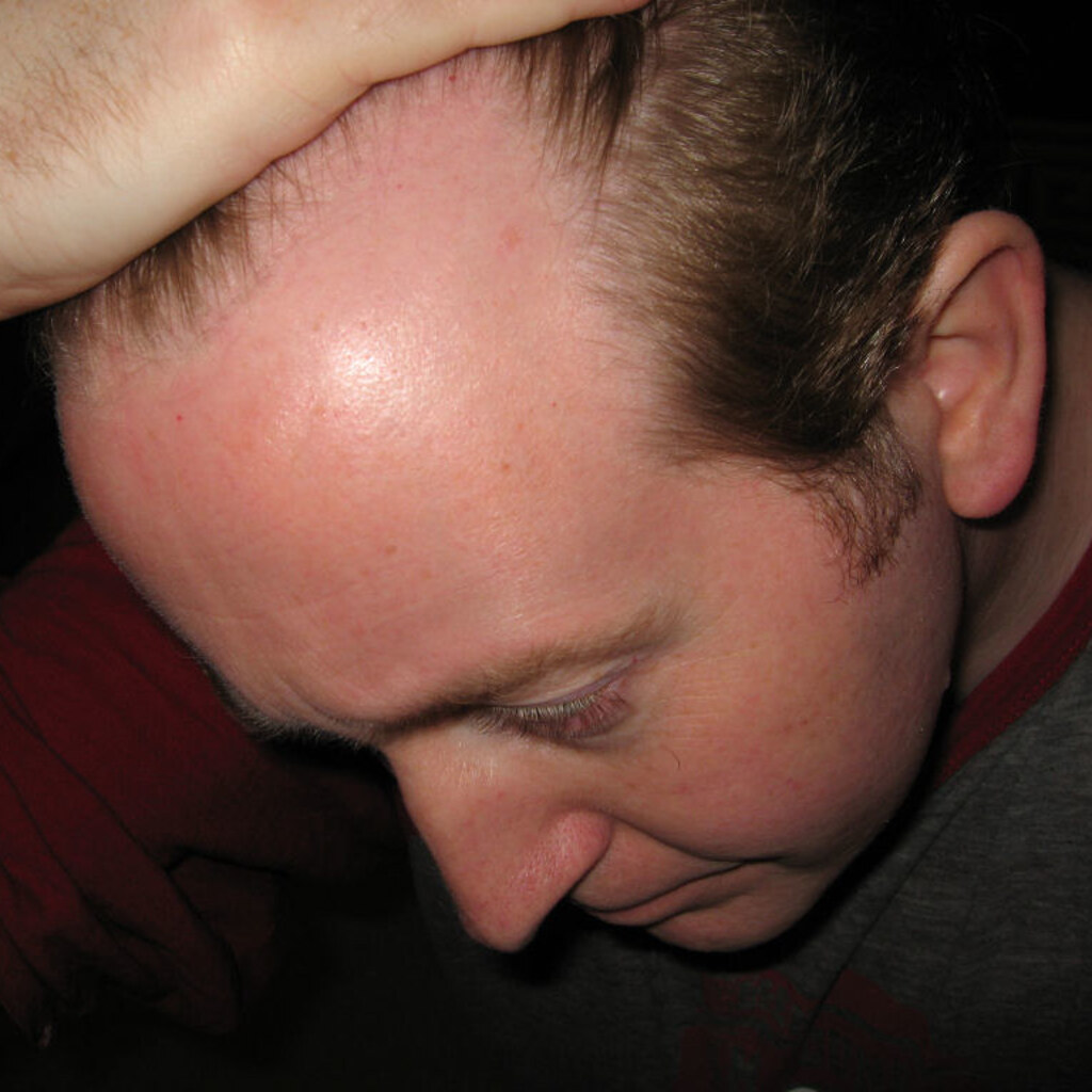 Photo of a man with a receding hairline