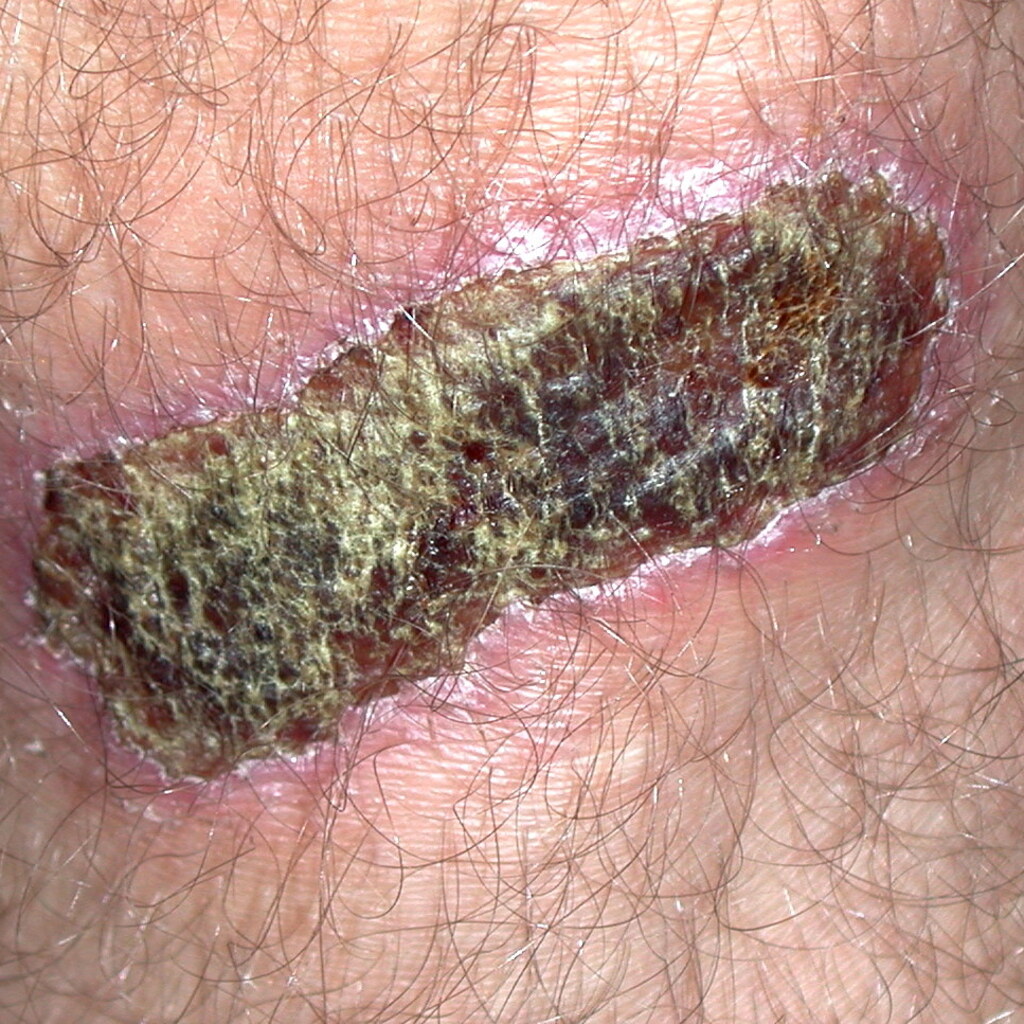 Photo of a scab