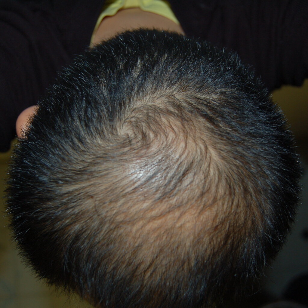 Photo of a man's scalp