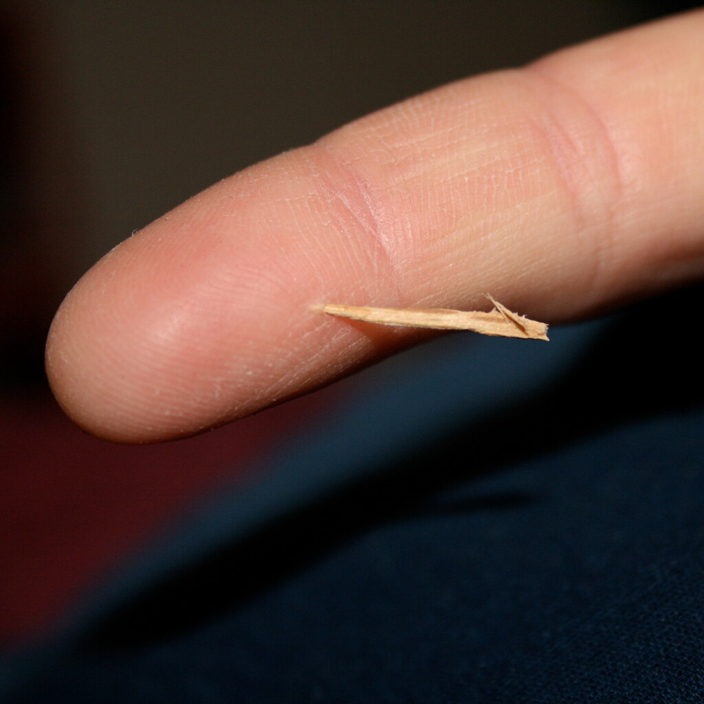 Photo of a finger with a splinter in it