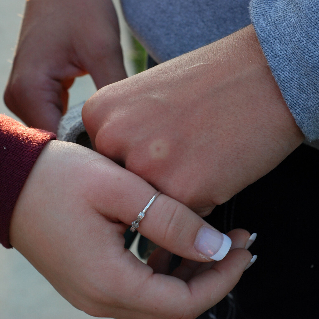 Photo of someone with a wasp sting