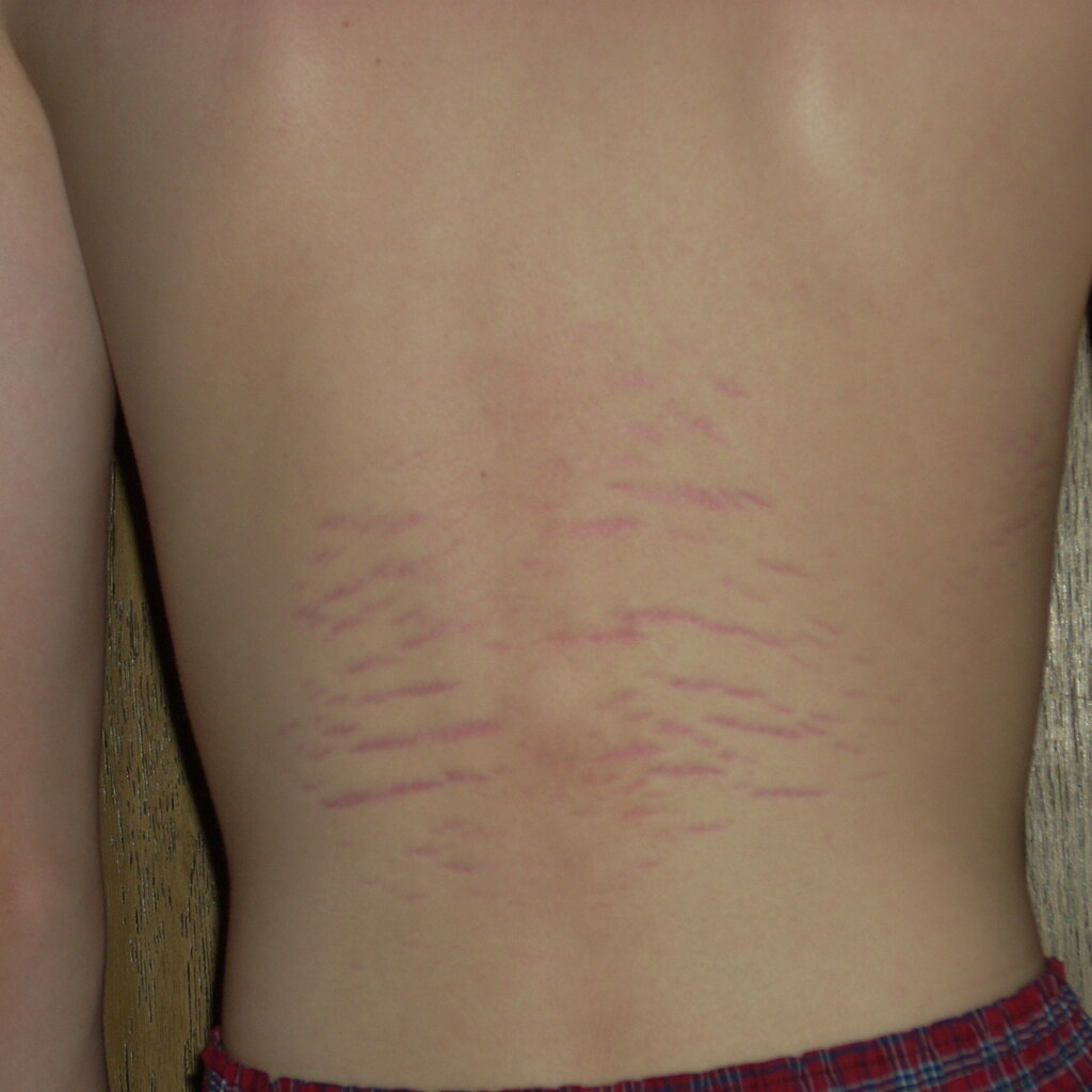 Stretch marks.