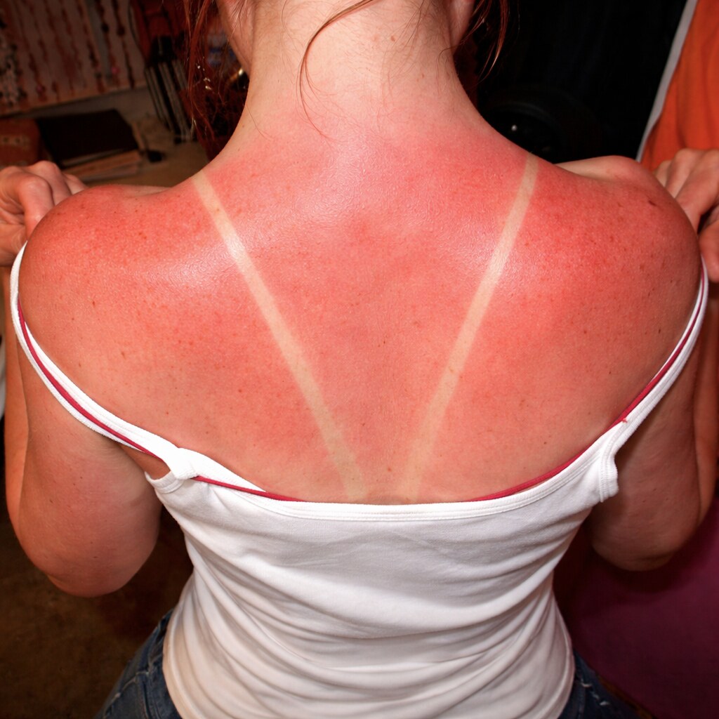 Photo of a sunburnt back