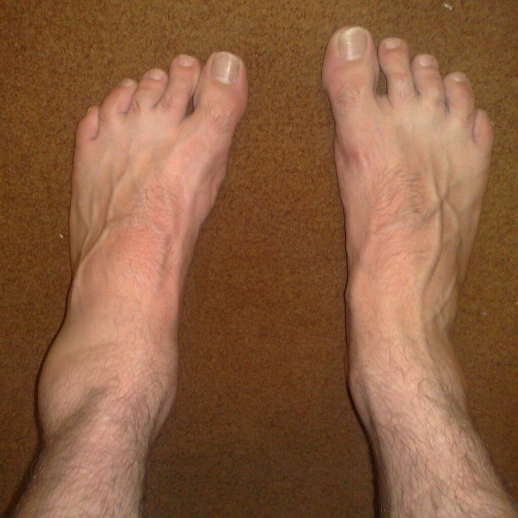 Photo of a man with a swollen ankle