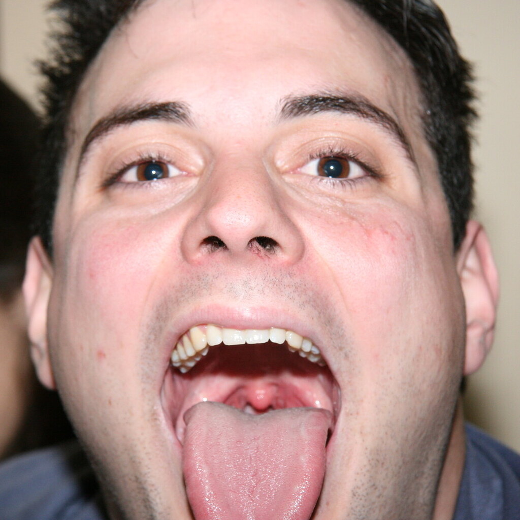 Photo of a man's tonsils