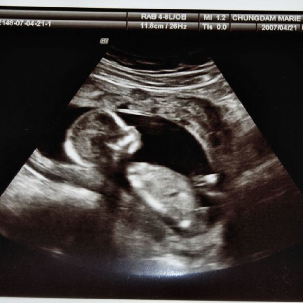 An ultrasound image