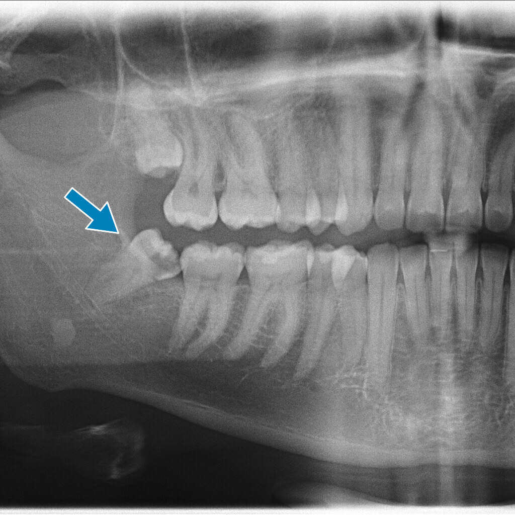 X-ray of wisdom teeth